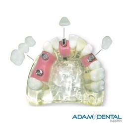 Dental Implant Dental/Education