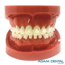 Upper And Lower Arch with Ceramic Brackets Dental