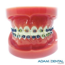 Upper And Lower Arch With Metal Brackets Dental/