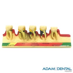 Gum Disease Dental/Education