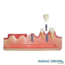 Implant Sequence Dental Demonstration Model